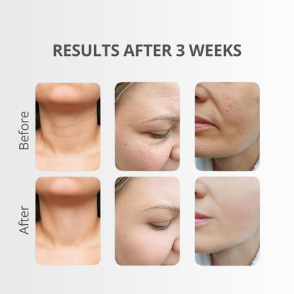 Before and after results of using 7 Color Neck Lifting Device