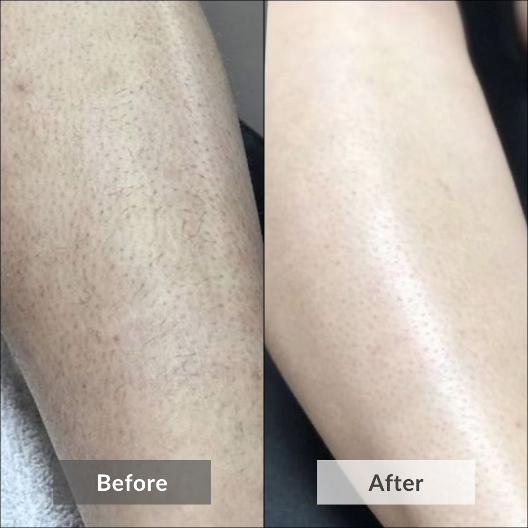 The picture shows the visible results of using Glow Getter Body Scrub by Auraé Beauty that is made of 100% organic ingredients and the best for strawberry skin, dry patches, dull and dry skin.