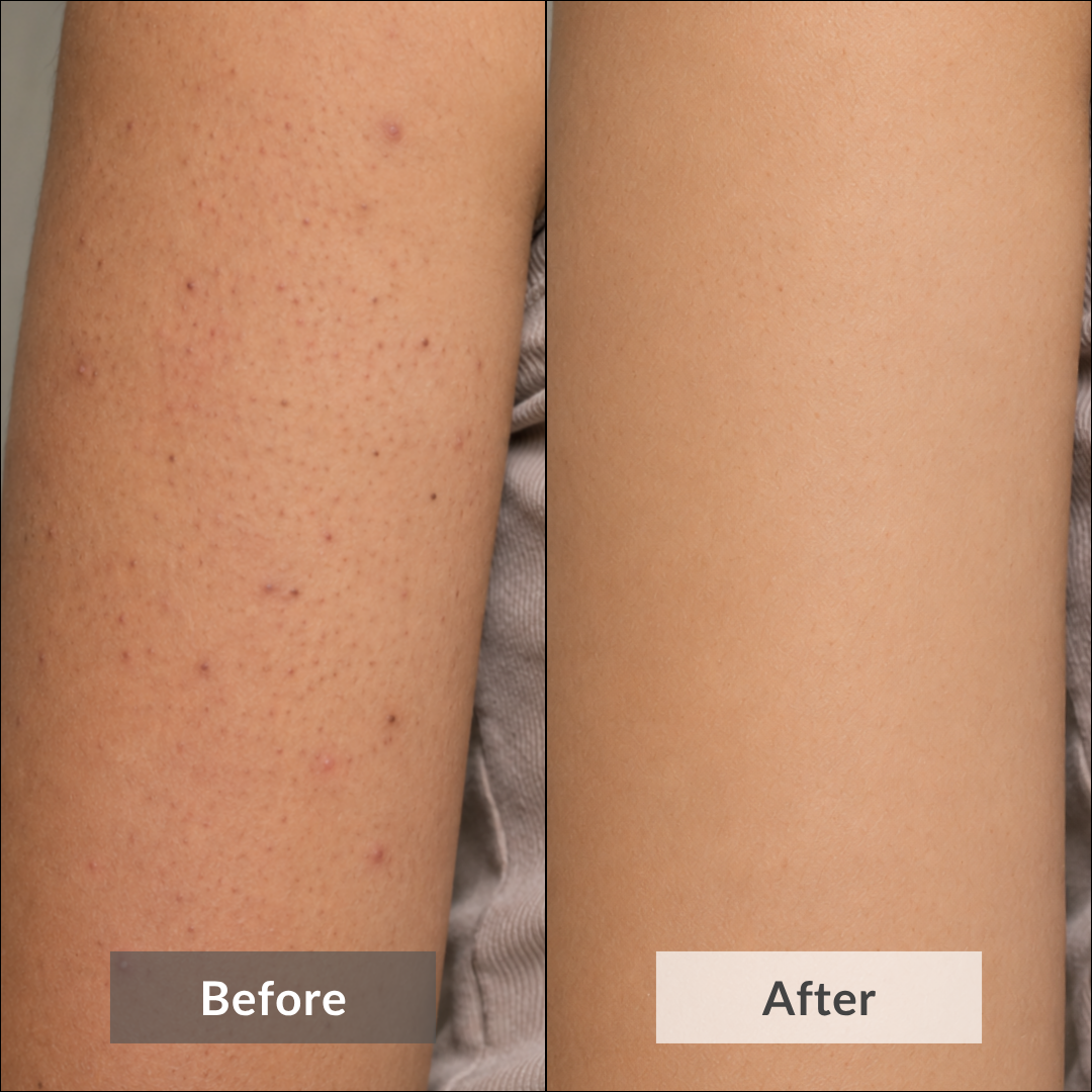 The picture shows the visible results of using Lavender Dream Body Scrub by Auraé Beauty that is made of 100% organic ingredients and the best for pre-shave exfoliation.