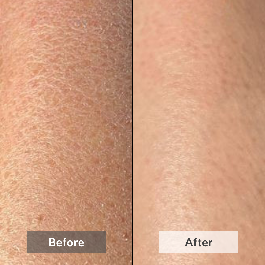 The picture shows the visible results of using Rose Velvet Body Scrub by Auraé Beauty that is made of 100% organic ingredients and the best for deep exfoliation, uneven skin, dull and dry skin.