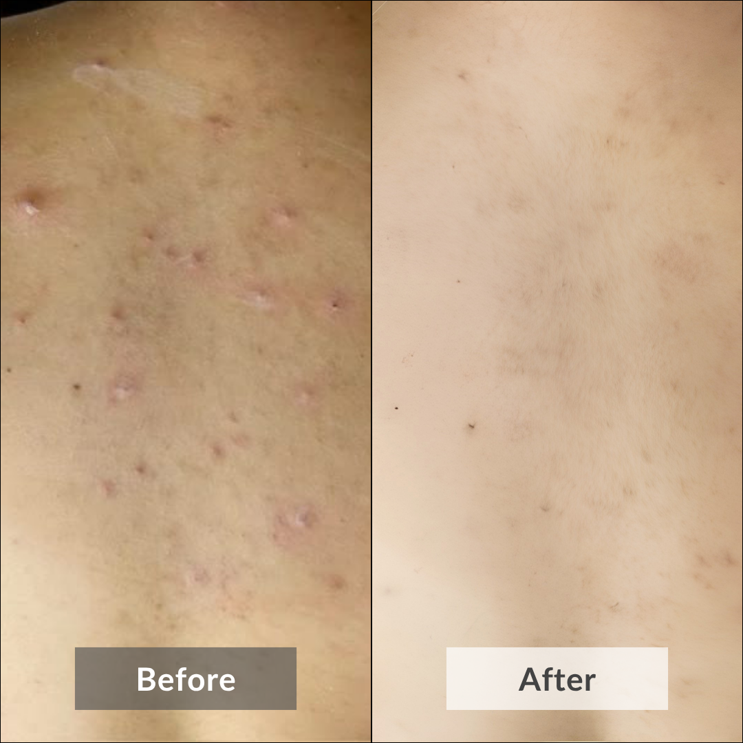 Before and after comparison of skin texture on a person's back. It clearly shows the back acne (bacne) is gone after using Ubtan Glow Body Scrub by Auraé Beauty.